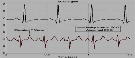 normal ekg reading vs abnormal.